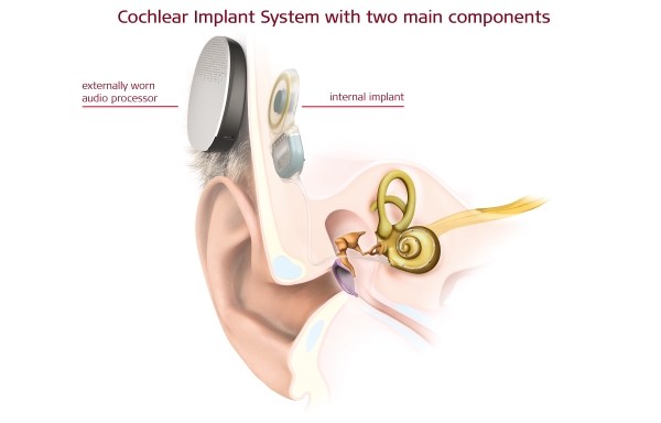 Un 1er dispositif totalement implantable posé avec succès en Belgique