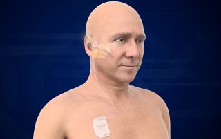 Première publication sur un nouvel implant complètement implantable