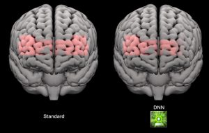 Une étude scientifique montre les effets sur le cerveau de Phonak Infinio Sphere