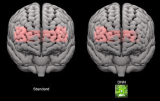 Une étude scientifique montre les effets sur le cerveau de Phonak Infinio Sphere