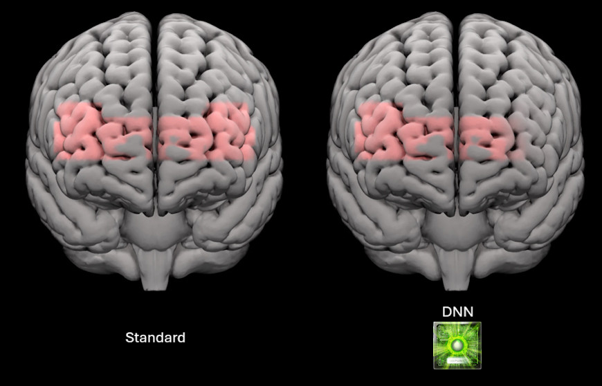 Une étude scientifique montre les effets sur le cerveau de Phonak Infinio Sphere