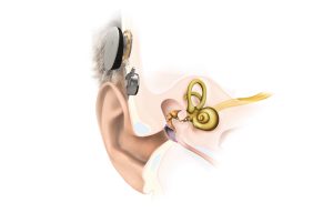 L’implant actif à conduction osseuse de Med-El est désormais pris en charge
