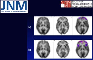Les aides auditives ralentiraient le déclin métabolique du cerveau