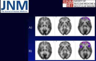 Les aides auditives ralentiraient le déclin métabolique du cerveau
