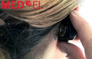 Prise en charge prolongée et simplifiée pour Adhear de Med-El