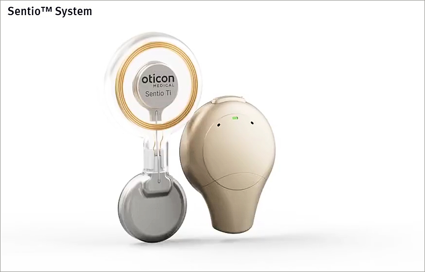 Le système d’implant auditif transcutané Sentio va être remboursé