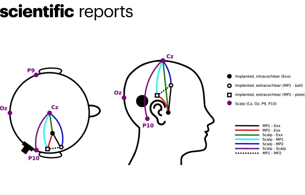 Des chercheurs enregistrent un électroencéphalogramme via un implant cochléaire